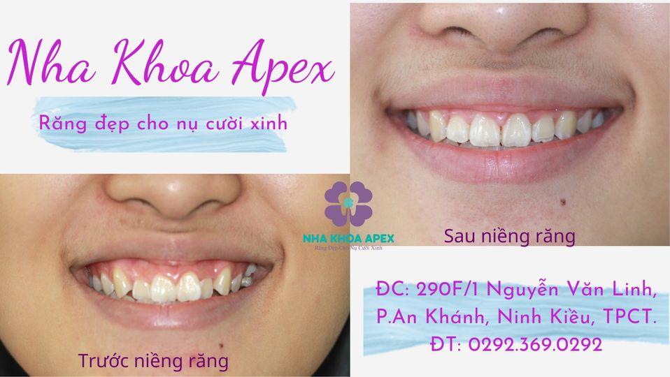 Dịch Vụ Niềng Răng tại NHA KHOA APEX